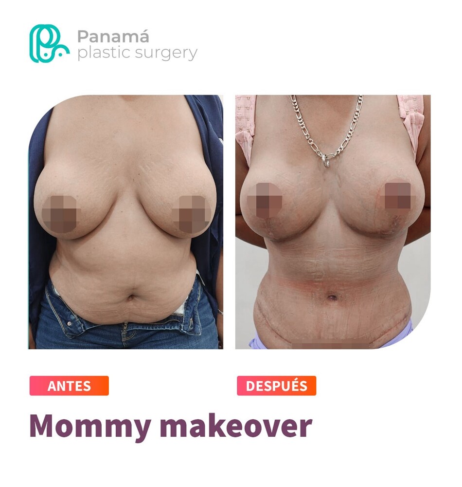 Before and After Result